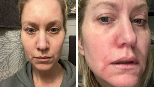 Anna's skin journey with Skinome