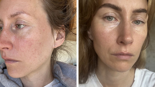 Louise's skin journey with Skinome