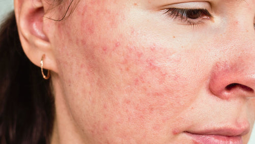 5 tips för dig som har rosacea