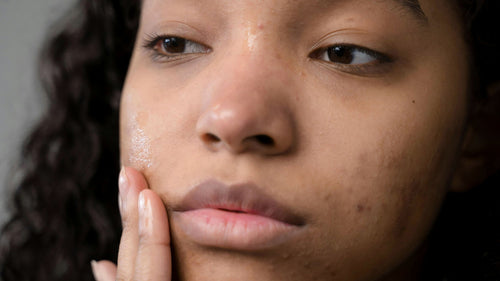 Our top tips for acne-prone skin