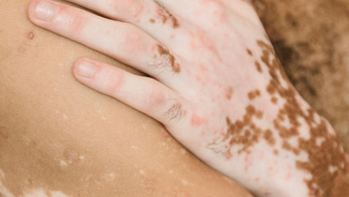 What you didn't know about vitiligo